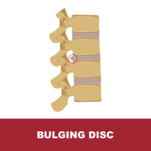 Bulging Disc Graphic Image