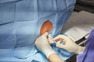 Doctor performing a procedure for the Epidural injection
