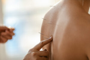Acupuncture back treatment