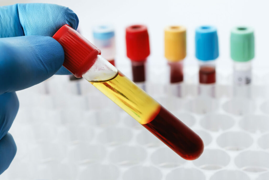 A vial of blood with platelet-rich plasma sitting at the top.