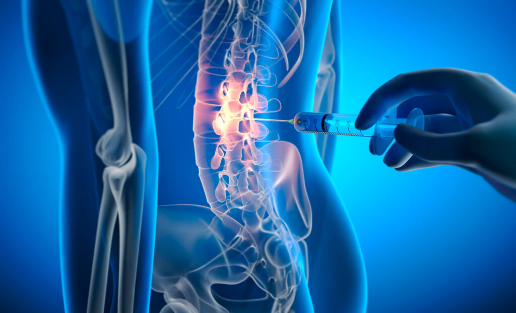 Facet joint injection for lower back pain treatment.