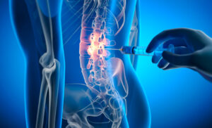 Facet joint injection for lower back pain treatment.